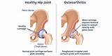 Photos of Exercises Hip Osteoarthritis