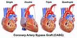 Images of Recovery From Quadruple Heart Bypass