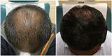 How Much Does Hair Loss Treatment Cost Photos