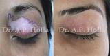 Segmental Vitiligo Treatment Photos