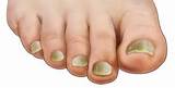Home Remedies For Thickened Toenails Pictures