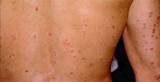 Images of What Is The Latest Treatment For Psoriasis