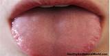 Blister On Side Of Tongue Treatment