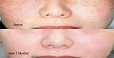 Pictures of Laser Treatment For Moles On Face Side Effects