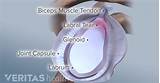 Labral Tear Shoulder Treatment Options Photos