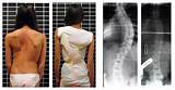 Cobb Angle Scoliosis Treatment Images
