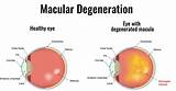 Photos of Vitamin Therapy For Macular Degeneration