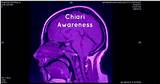 Chiari Malformation Headache Treatment Images