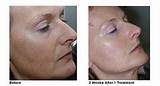 Photos of Spot Removal Facial