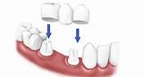 Dental Crown Steps Images