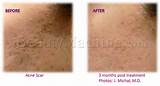 Pictures of Micropen Treatment Cost