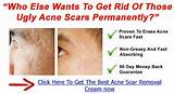 Pictures of Best Acne Scar Fade Treatment