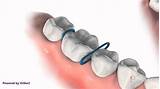 Orthodontic Separators Images