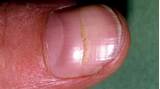 Bad Fingernails Treatment