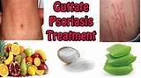 Guttate Psoriasis Home Remedies Images