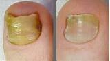 Psoriasis Fingernails Home Remedies Pictures