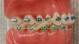 Orthodontic Elastics Photos