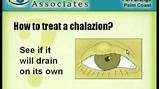 Chalazion Surgery Recovery Time Images