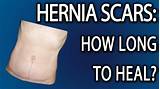 Photos of How Long Is Recovery After A Hernia Operation