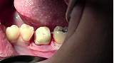 Photos of Clinical Crown Lengthening