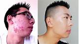 Images of How To Cover Up Acne With Makeup