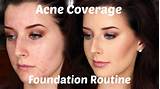 Makeup For Acne Scarred Skin Photos