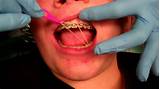 Orthodontic Elastics Pictures