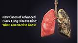 Photos of Advanced Lung Disease Symptoms