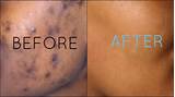 Dark Spot Removal African American Skin