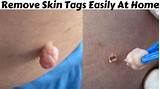 Skin Tags Home Remedies Baking Soda Pictures