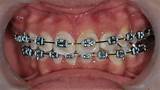 Orthodontic Chains Photos