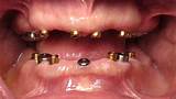 Images of Gold Teeth Dentures