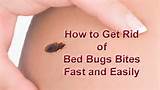 Photos of Fast Treatment For Bed Bugs