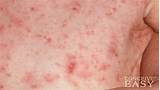 Scabies Doctor Pictures