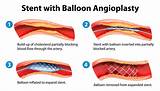 Photos of How Long Is Stent Recovery