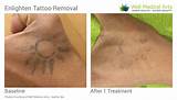 Images of Laser Tattoo Removal Pictures After Each Treatment