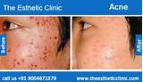 Best Acne Scar Doctor In The World