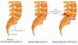 Vacuum Phenomenon Lumbar Spine Treatment Pictures