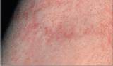 Home Remedies Scarlet Fever Pictures