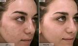 Pictures of Clean And Clear Vs Neutrogena Acne Spot Treatment