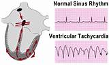 Images of Ep Study And Ablation Recovery Time