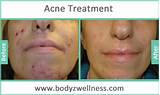 Prescribed Acne Treatment Images
