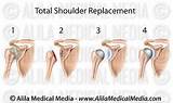 Shoulder Replacement Recovery