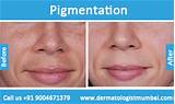 Photos of Laser Treatment For Skin Pigmentation Side Effects