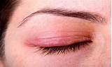 Pictures of Home Remedies For Styes On Upper Eyelid
