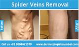 Photos of Latest Treatment For Spider Veins