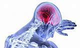 Anoxic Brain Injury Recovery Statistics Photos