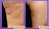 Photos of Surgical Cellulite Treatment