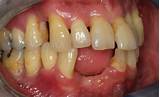 Images of Can Tooth Implant Cause Sinus Problems
