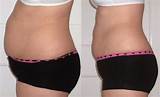 Images of What Is Strawberry Laser Lipo Treatment